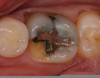 Tooth Fracture Molar Image