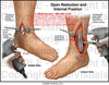 Internal Fixation Ankle Image
