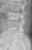 Pagets Disease Spine Image
