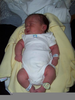Dwarfism Newborn Image