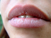 Oral Herpes Lips Image