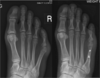 Tailors Bunion Xray Image